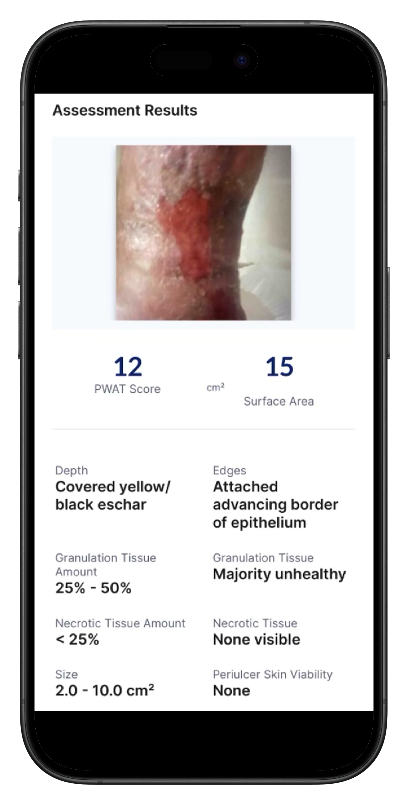 WoundSys app showing assessment results with PWAT score and wound metrics